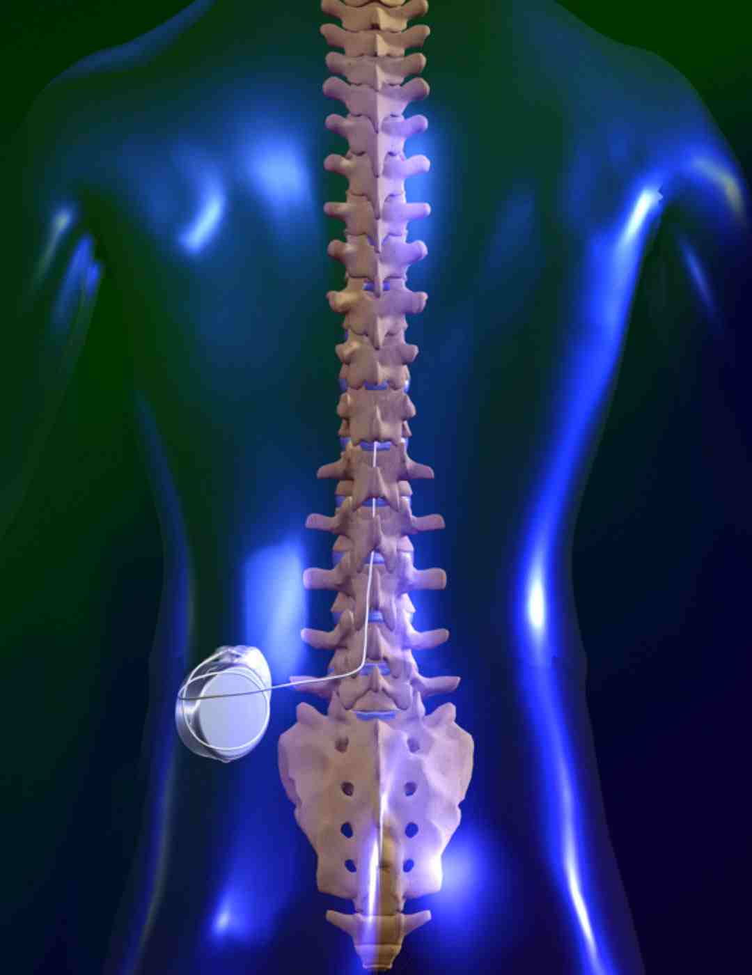 implanting abbott spinal cord stimulator